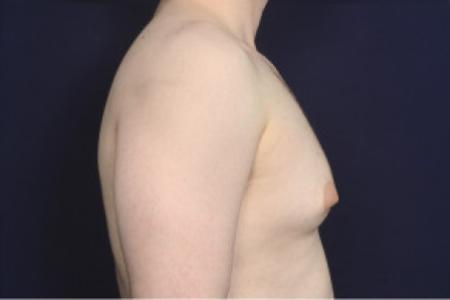 Before image 3 Case #102501 - Gynecomastia