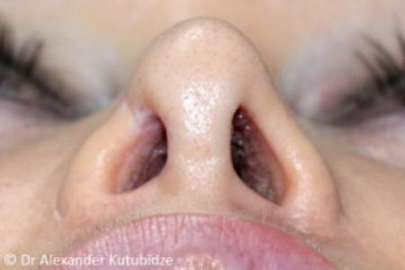 Before image 6 Case #103351 - Revision Rhinoplasty. 3 years after