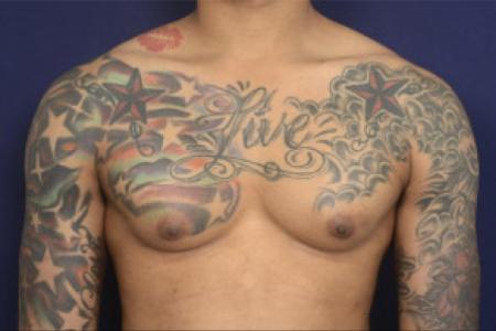 Before image 1 Case #102466 - Gynecomastia
