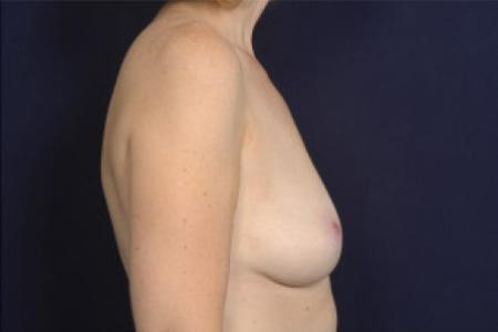 Before image 3 Case #102571 - Breast Augmentation