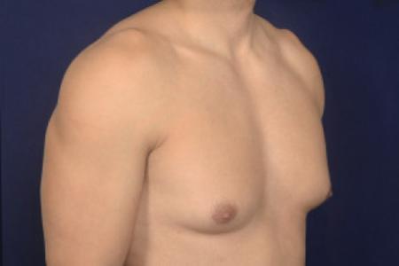 Before image 2 Case #102411 - Gynecomastia