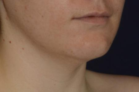Before image 2 Case #102801 - Neck Lift