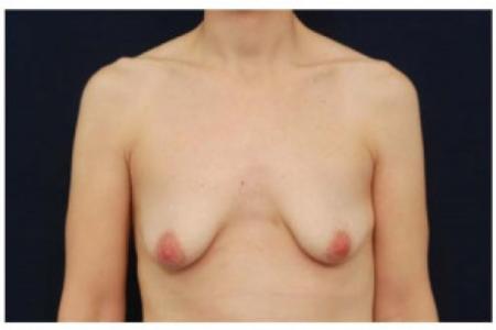Before image 1 Case #103001 - Augmentation Mastopexy