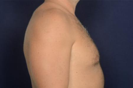 Before image 3 Case #102446 - Gynecomastia
