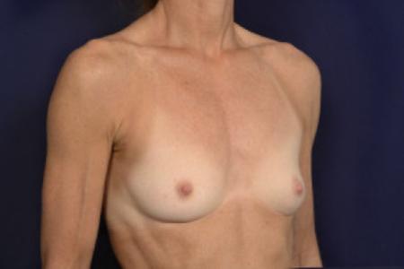 Before image 2 Case #102566 - Breast Augmentation