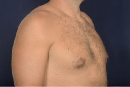 Before image 2 Case #102446 - Gynecomastia