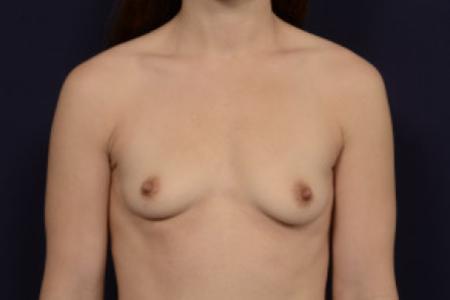Before image 1 Case #102736 - Breast Augmentation
