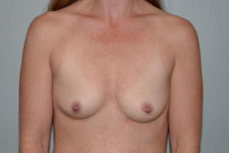 Before image 1 Case #101601 - Breast Augmentation