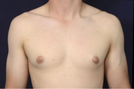 Before image 1 Case #102461 - Gynecomastia