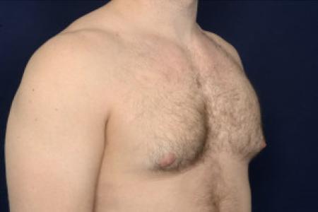Before image 2 Case #102386 - Gynecomastia