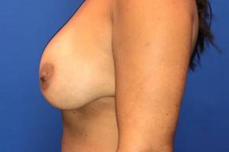 Before image 3 Case #103271 - Bilateral Implant Explanation with En-Bloc Capsulectomies for a 44 year old female