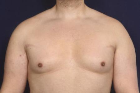 Before image 1 Case #102526 - Gynecomastia
