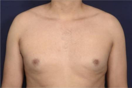 Before image 1 Case #102366 - Gynecomastia