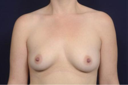 Before image 1 Case #102541 - Breast Augmentation