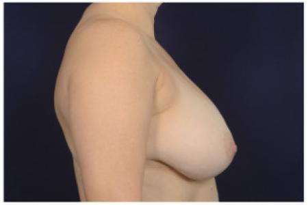 Before image 3 Case #102341 - Breast Reduction