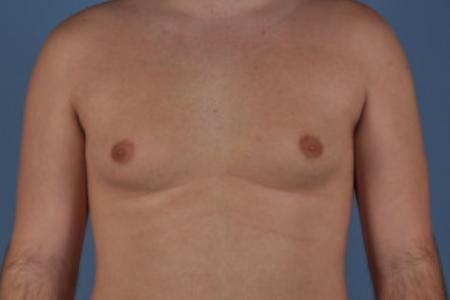 Before image 1 Case #103221 - Male Breast Reduction