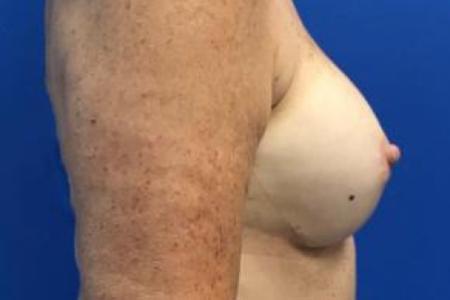 Before image 3 Case #103256 - Silicone Gel Implants for a 53 year old female.