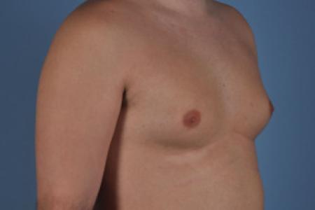 Before image 2 Case #103221 - Male Breast Reduction