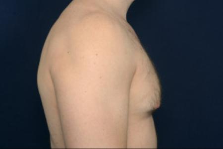 Before image 3 Case #102386 - Gynecomastia
