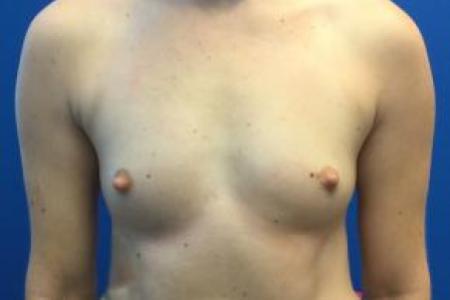 Before image 1 Case #103246 - Silicone Breast Augmentation for a 36 year old female