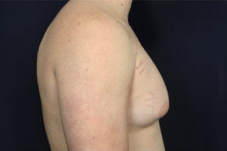 Before image 3 Case #102376 - Gynecomastia