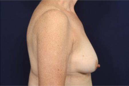 Before image 3 Case #103106 - Fat Grafting of Breasts