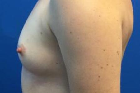 Before image 3 Case #103246 - Silicone Breast Augmentation for a 36 year old female