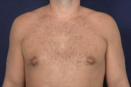 Before image 1 Case #102446 - Gynecomastia
