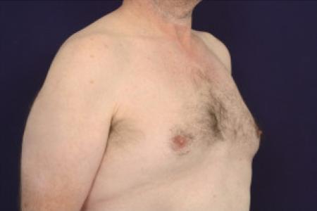 Before image 2 Case #102621 - Gynecomastia 