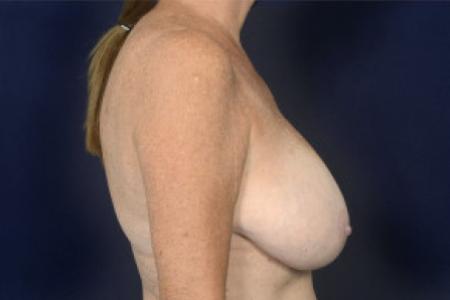 Before image 3 Case #102391 - Breast Reduction