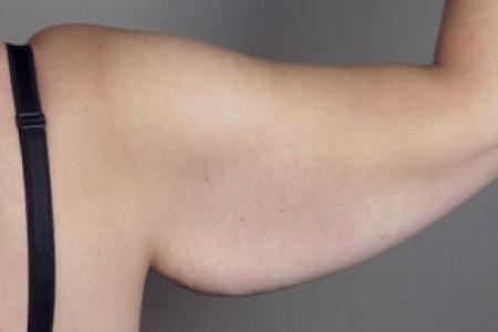 Before image 4 Case #103136 - Upper Arm Lift 15