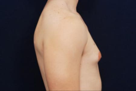 Before image 3 Case #102681 - Gynecomastia