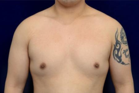 Before image 1 Case #102731 - Gynecomastia