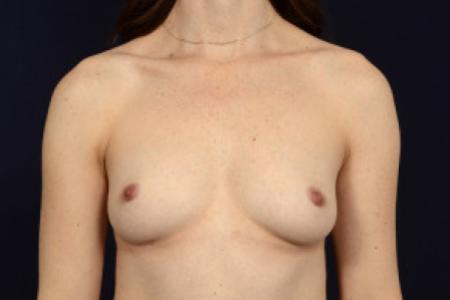 Before image 1 Case #103096 - Fat Grafting of Breasts