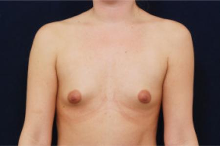 Before image 1 Case #102711 - Breast Augmentation