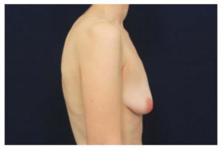 Before image 3 Case #103001 - Augmentation Mastopexy