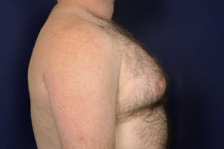 Before image 3 Case #102481 - Gynecomastia