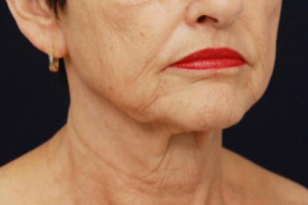 Before image 2 Case #102781 - Lower Facial Rejuvenation