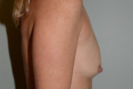 Before image 2 Case #101601 - Breast Augmentation