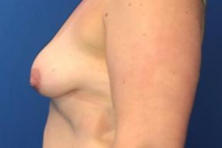 Before image 3 Case #103276 - Silicone Breast Augmentation for a 38 year old female