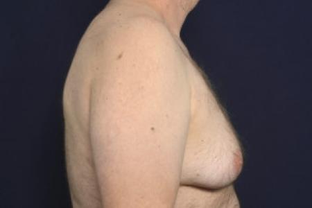 Before image 3 Case #102426 - Gynecomastia