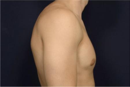 Before image 3 Case #102751 - Gynecomastia