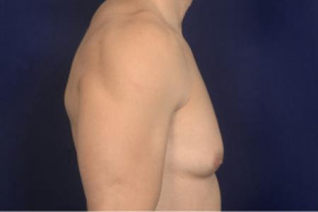 Before image 3 Case #102411 - Gynecomastia