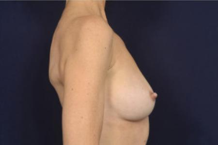 Before image 3 Case #102371 - Breast Augmentation Revision