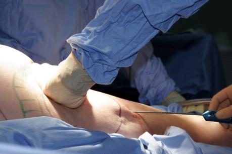 Common Myths about Liposuction