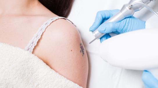 Laser Tattoo Removal: Is A Doctor Your Best Option?