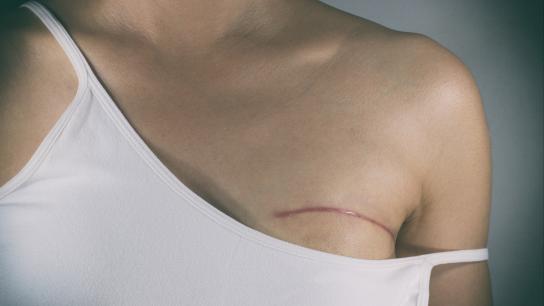 The Lowdown on the Latest Techniques for Hiding Surgical Scars