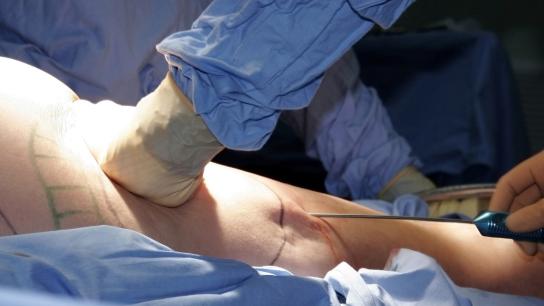 Liposuction plastic surgery procedure