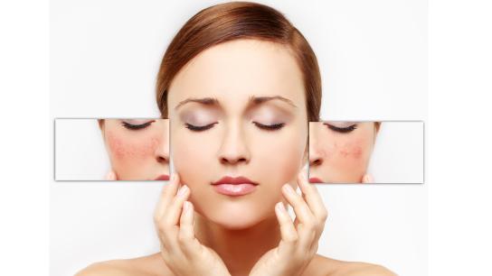 Woman examining skin for broken capillaries