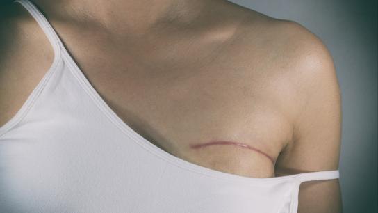 A woman's post surgical scar from plastic surgery